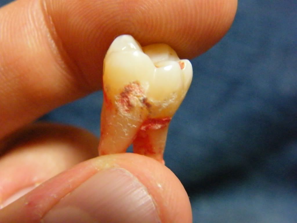 Wisdom Tooth Photo by ftfr4k | Photobucket